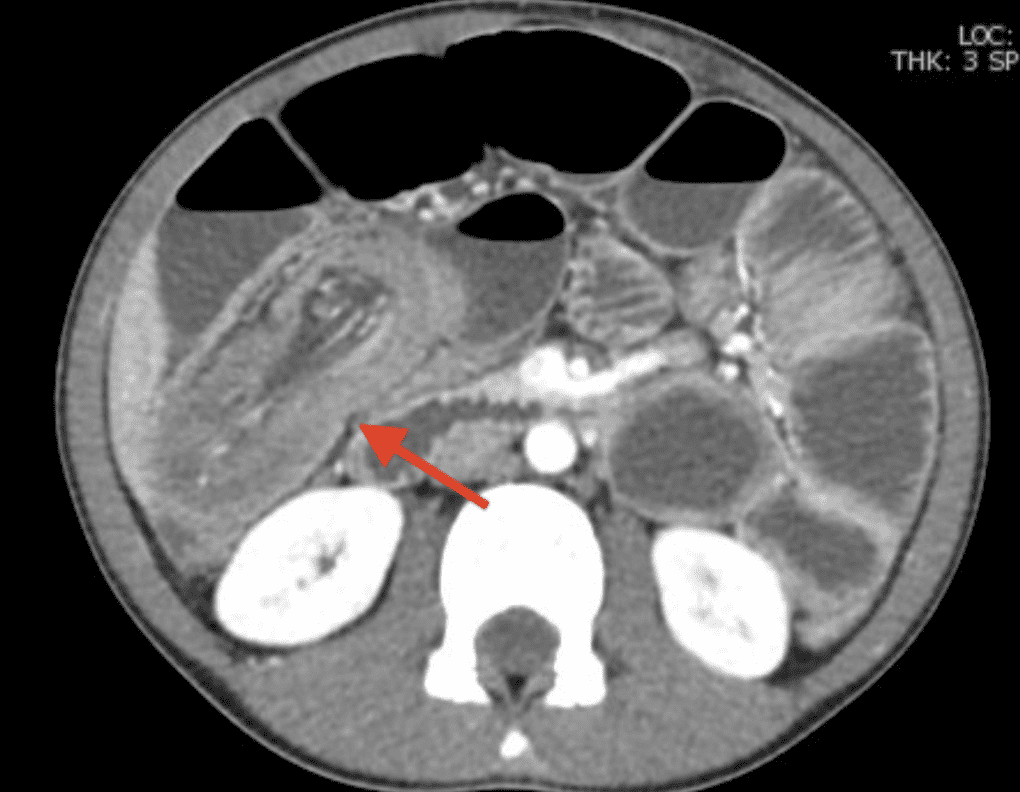 Intussusception Uams Department Of Radiology