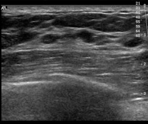 Ultrasound image of a breast