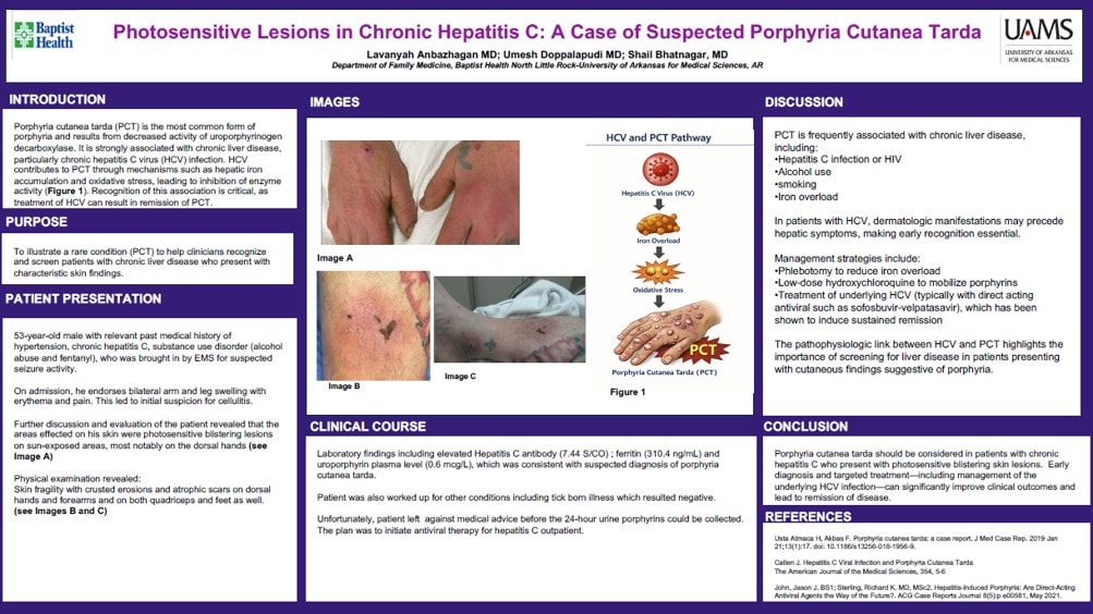 Academic case-report poster titled 'Photosensitive Lesions in Chronic Hepatitis C: A Case of Suspected Porphyria Cutanea Tarda' by Anbazhagan, Doppalapudi, and Bhatnagar. The poster has a dark purple color scheme with sections for Introduction, Purpose, Patient Presentation, Images (three clinical photos labeled A, B, and C), a pathway diagram (Figure 1) showing how Hepatitis C leads to PCT, Clinical Course, Discussion, Conclusion, and References. Detailed text and image descriptions are linked above this image.