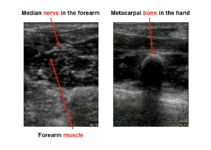 Ultrasound demonstration picture, showing the median nerve in the forearm, a forearm muscle, and a metacarpal bone in a hand.