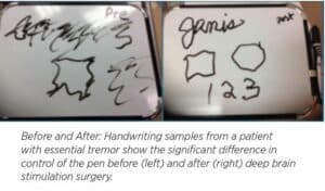 Before and after treatment handwriting samples