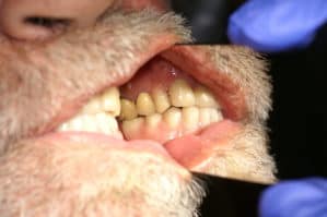 Image of teeth during final fitting
