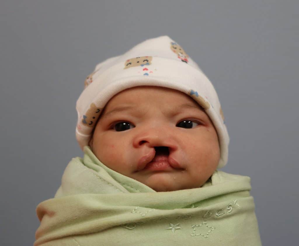 Photo of baby with cleft lip and palate before Nasoalveolar Molding