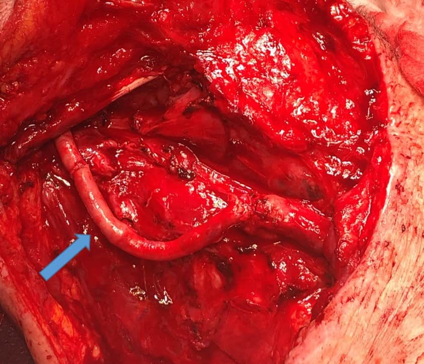 Case Study: Squamous cell carcinoma removal with carotid involvement