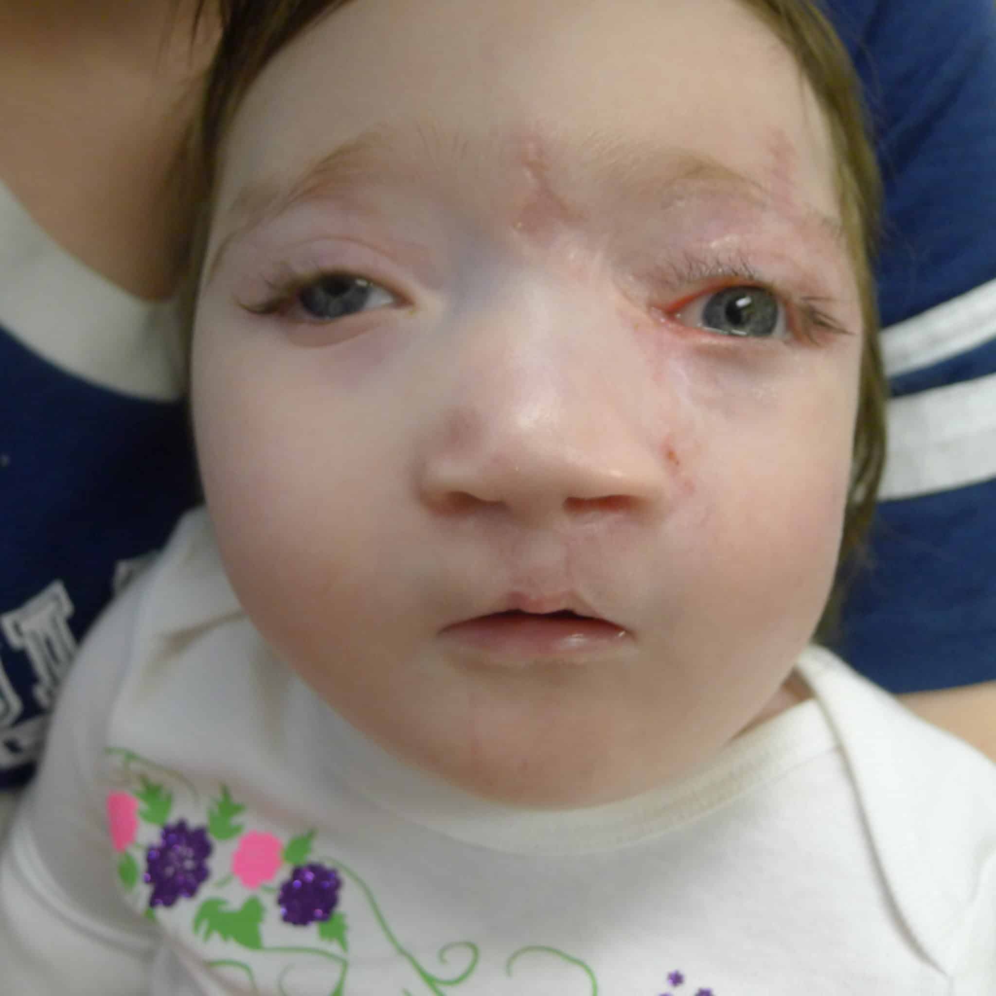 Patient 1 at 6 months after surgery.