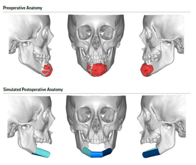 Medical Case Study: Mandibulectomy with Fibula Free Flap Reconstruction ...