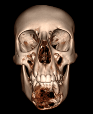 x-ray image showing the skull of the patient before surgery