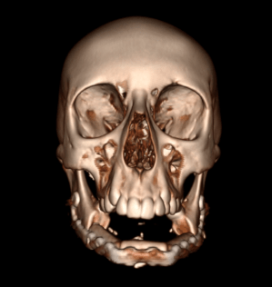 X-ray of the patient’s skull after surgery
