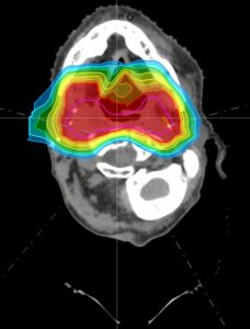 MRI image of a person's mouth and throat. Colored overlays show the amount of proton radiation used in the area