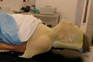 Image of person wearing custom mask for proton therapy