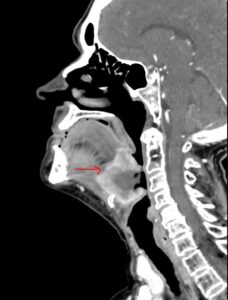 MRI image of a person's mouth and throat. A red arrow points to a particular position