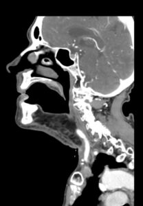 MRI image of a person's mouth and throat