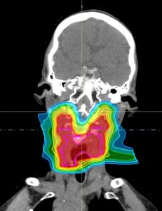 MRI image of a person's mouth and throat. Colors show the amount of proton radiation in areas