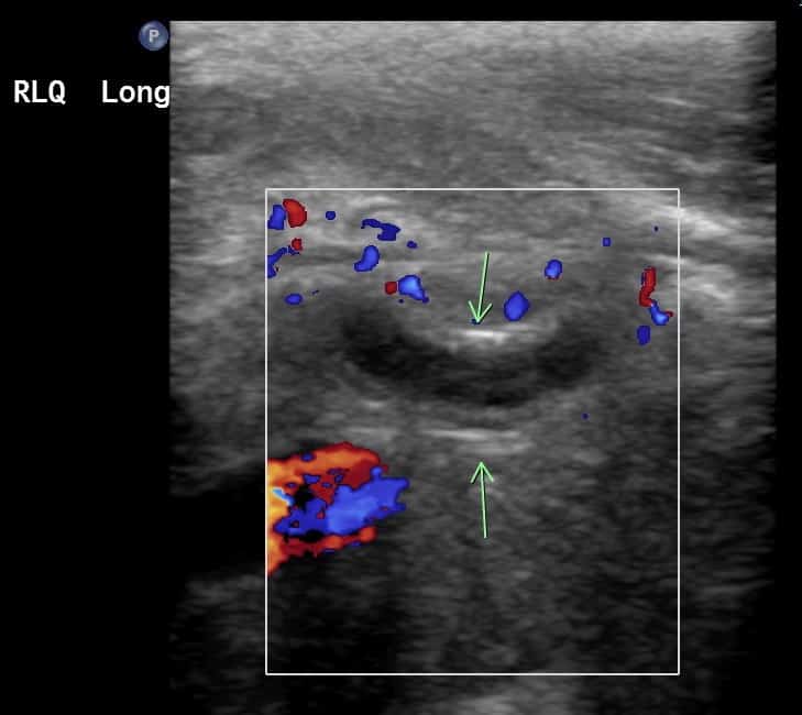 Static image of a color ultrasound.