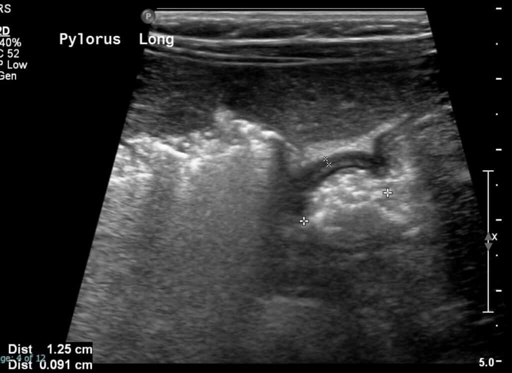 Static ultrasound grayscale image of the pylorus in its longitudinal dimension demonstrates normal wall thickness.