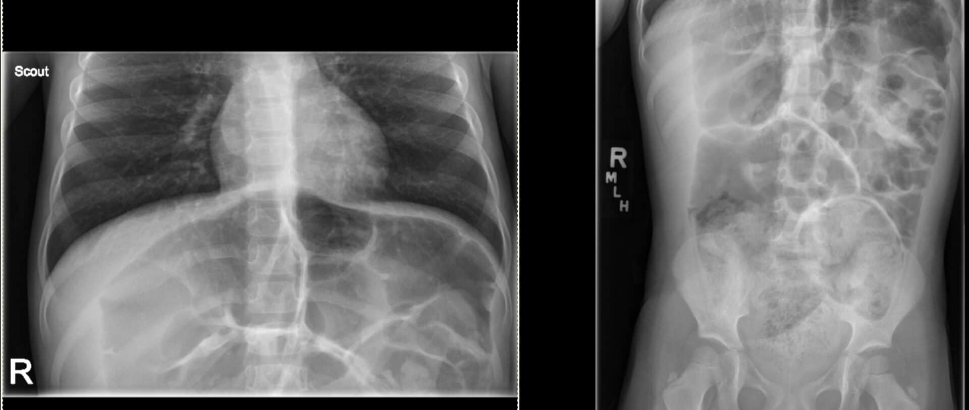 Hirschsprung’s Disease | UAMS Department Of Radiology