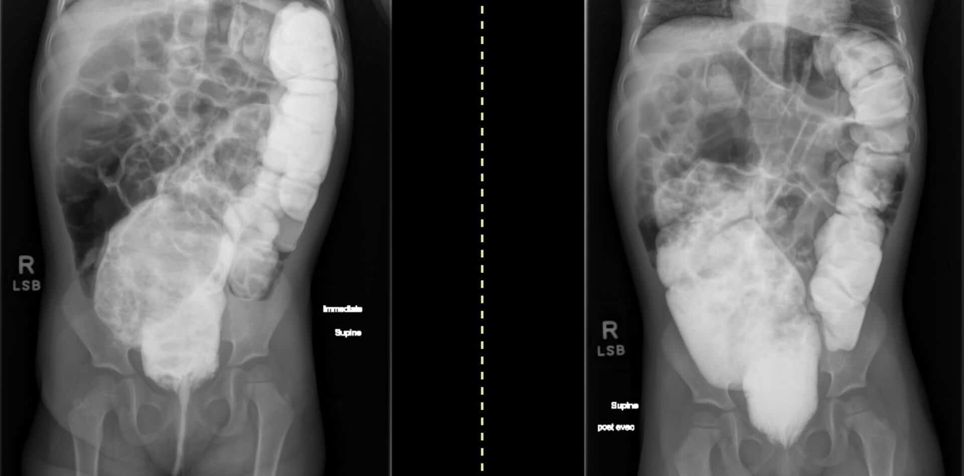 Hirschsprungs Disease Uams Department Of Radiology