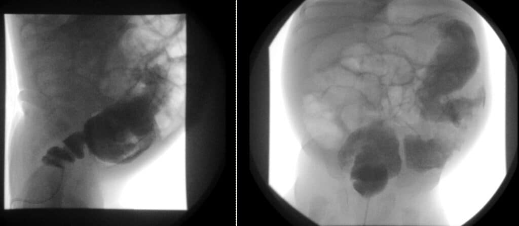 Here's a five year old with textbook appearance of a spiculated rectum on contrast enema administration. Recall this happens due to ineffective, non peristaltic contractions of the abnormally functioning rectum.  Also note reversal of the recto-sigmoid ratio.