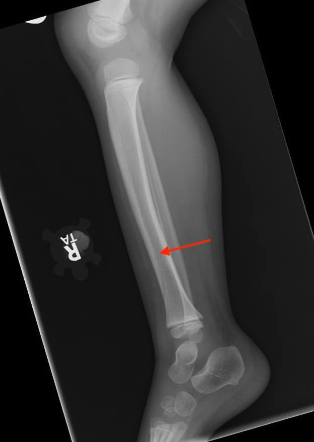 Lower Limb Radiograph - Spiral/Toddler's Fracture