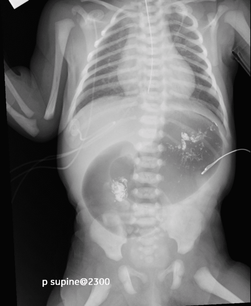AP Abdomen X-Ray -  showing "Double Bubble" sign