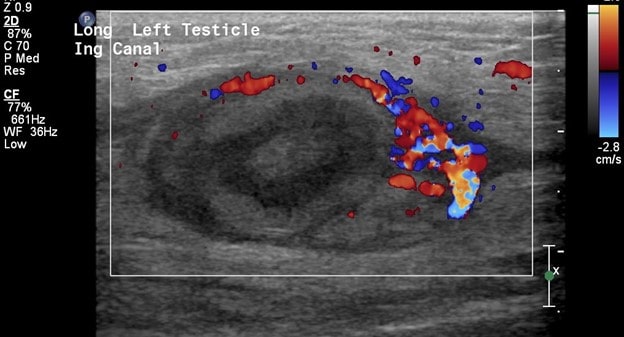 color ultrasound of the left inguinal canal containing the left testicle