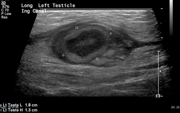 Inguinal Ultrasound - Enlarged Oval Structure