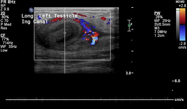 Inguinal Ultrasound - Spectral Doppler of Oval Mass