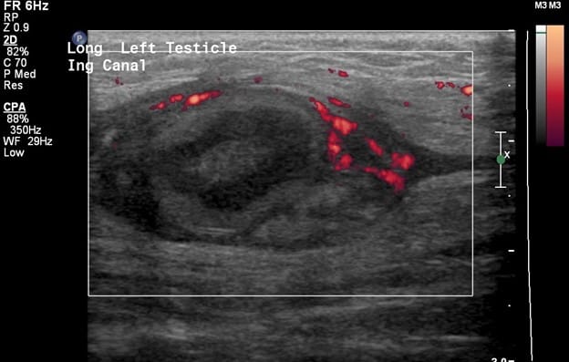 power doppler ultrasound of the left inguinal canal containing the left testicle