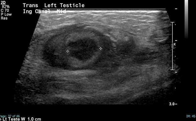 Inguinal Ultrasound- Left Infarcted Inguinal Testicle