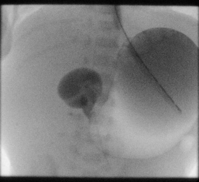 spot fluoroscopic image of the stomach