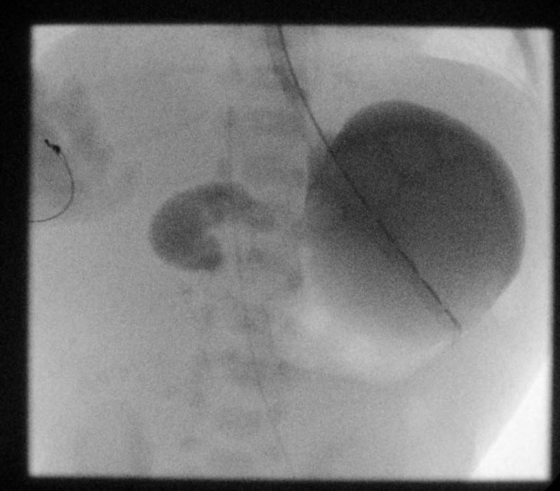 spot fluoroscopic image of the stomach