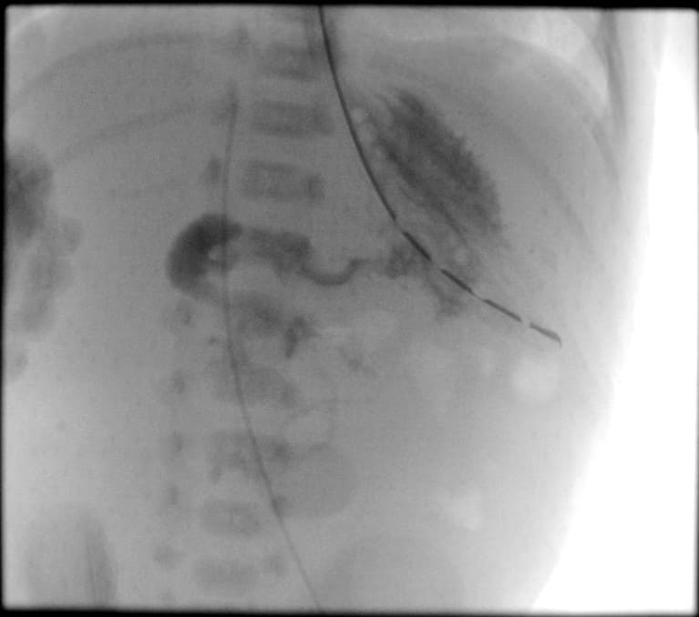 spot fluoroscopic image of the stomach and small bowel