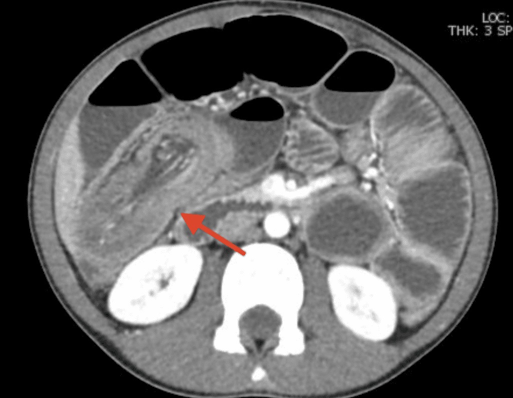 contrast enhanced axial CT demonstrating small bowel intussusception 