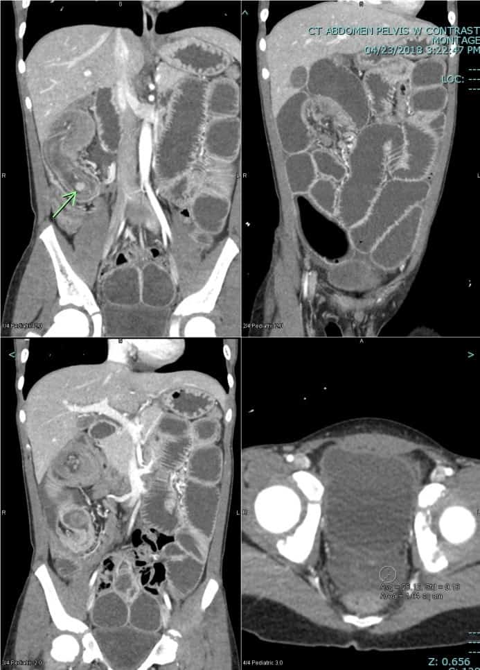 multiple coronal and axial ct images