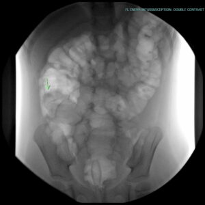 Intussusception | UAMS Department of Radiology