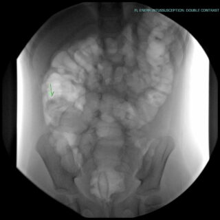 Intussusception | UAMS Department of Radiology