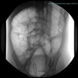 Intussusception | UAMS Department of Radiology