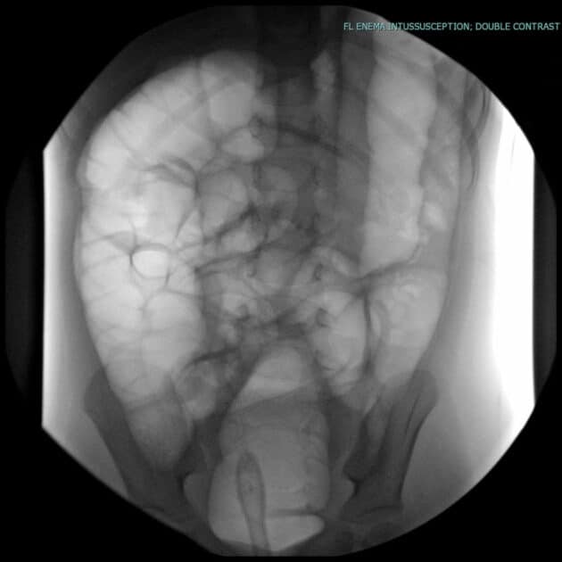 Intussusception Uams Department Of Radiology