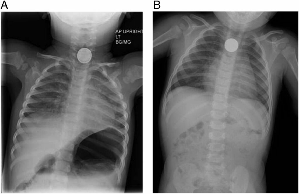 chest X-ray with foreign body