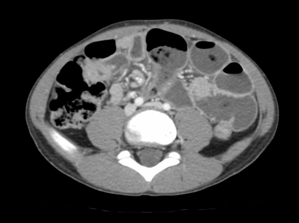 Additional axial post-contrast CT image in the same patient demonstrates a singular partially visualized hyperdense circular foreign object in the right hemiabdomen correlating to known magnets with associated small bowel tethering, ultimately requiring 3 small bowel resections.