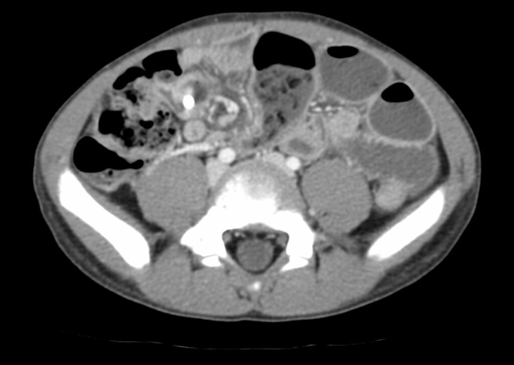 Additional axial post-contrast CT image in the same patient demonstrates a singular partially visualized hyperdense circular foreign object in the right hemiabdomen correlating to known magnets with associated small bowel tethering, ultimately requiring 3 small bowel resections.