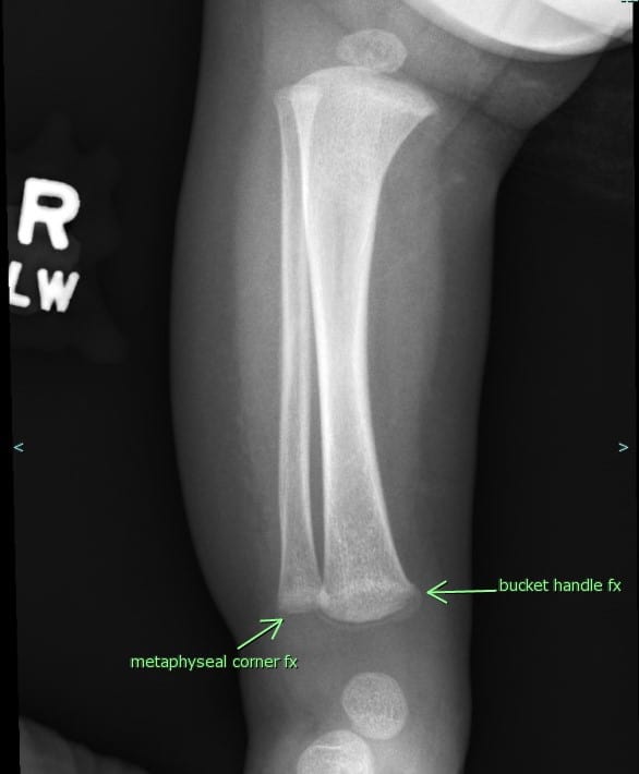 Frontal radiograph of the right distal lower extremity