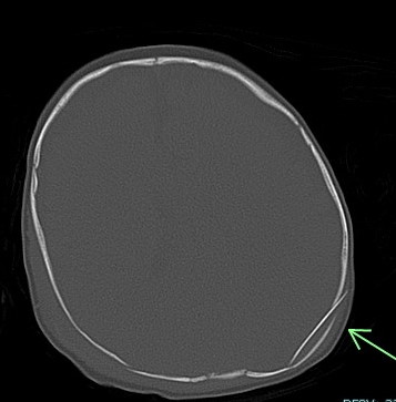 Axial CT Brain - depressed ping pong like fracture