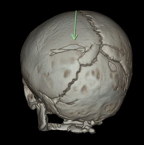 3D reconstructions of calvarium - comminuted & depressed skull fracture