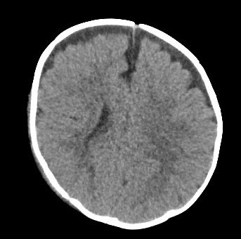 Axial noncontract CT head - traumatic subdural hemorrhage evaluation
