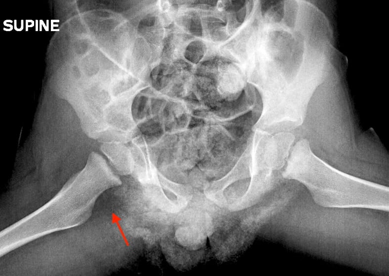 Frog Leg Radiograph - Abnormal Joint Fluid in Distended Hip Joint
