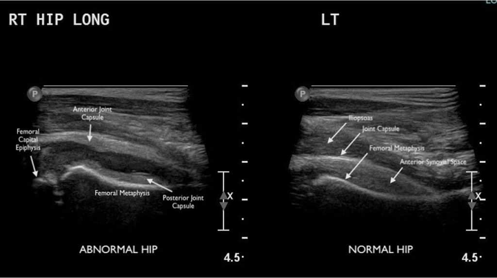 Ultrasound of Abnormal Right Hip and Normal Left Hip