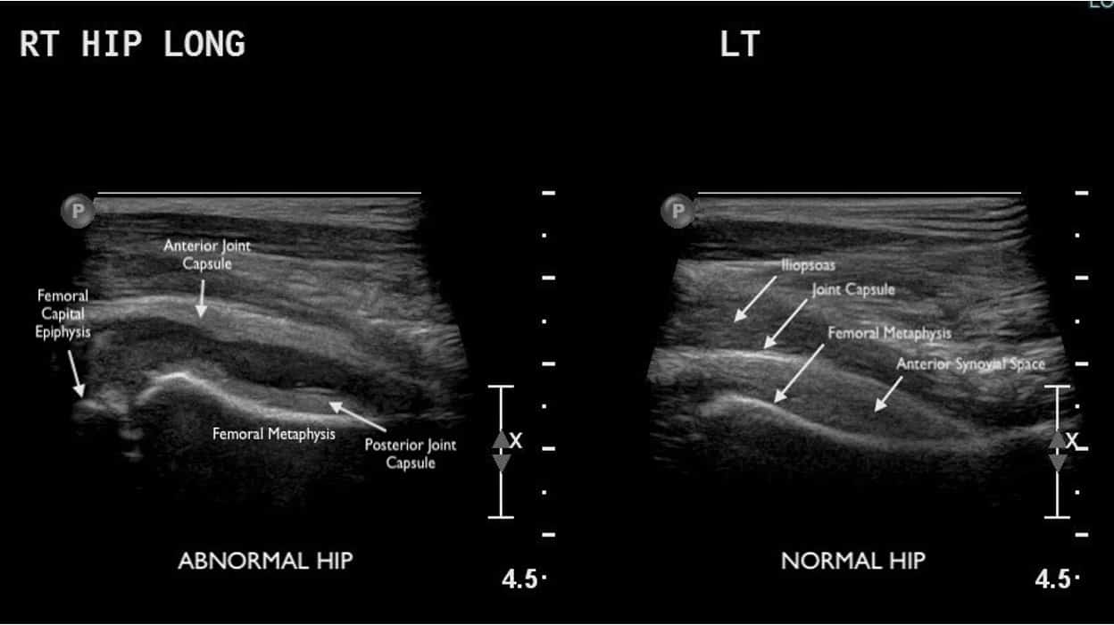 Irritable Hip | UAMS Department Of Radiology