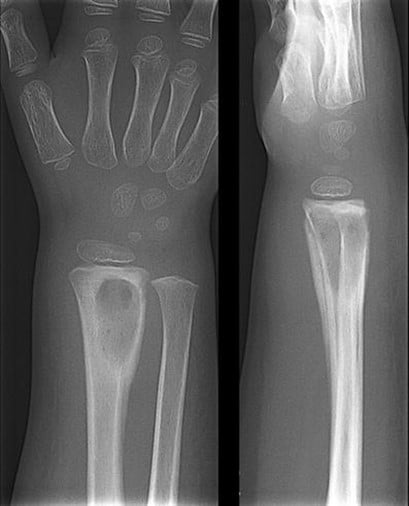 Wrist Radiograph - Osteomyelitis of radius