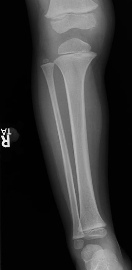 Unique Traumatic Fracture Patterns In Kids | UAMS Department of Radiology